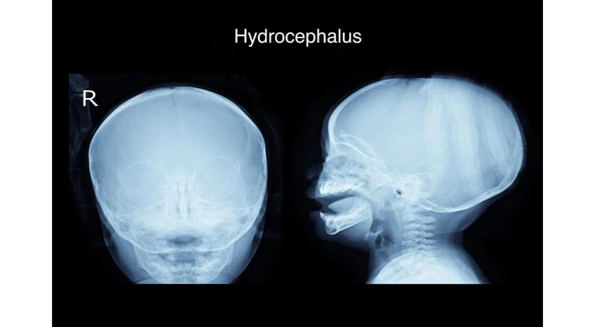 Hidrocefalia la copii: cauze, manifestări și metode de tratament