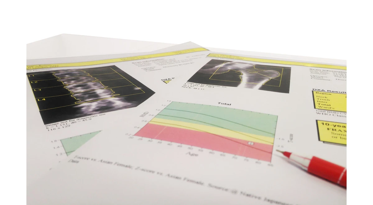 Osteodensitometrie cu ultrasunete vs cu radiatii (DEXA) - care sunt diferentele? 